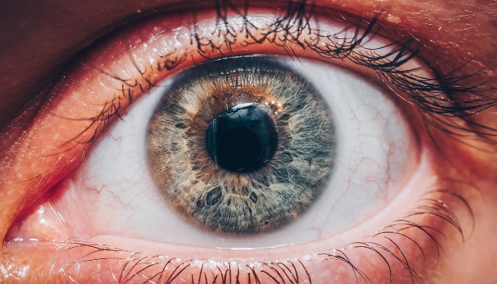Glaucoma
